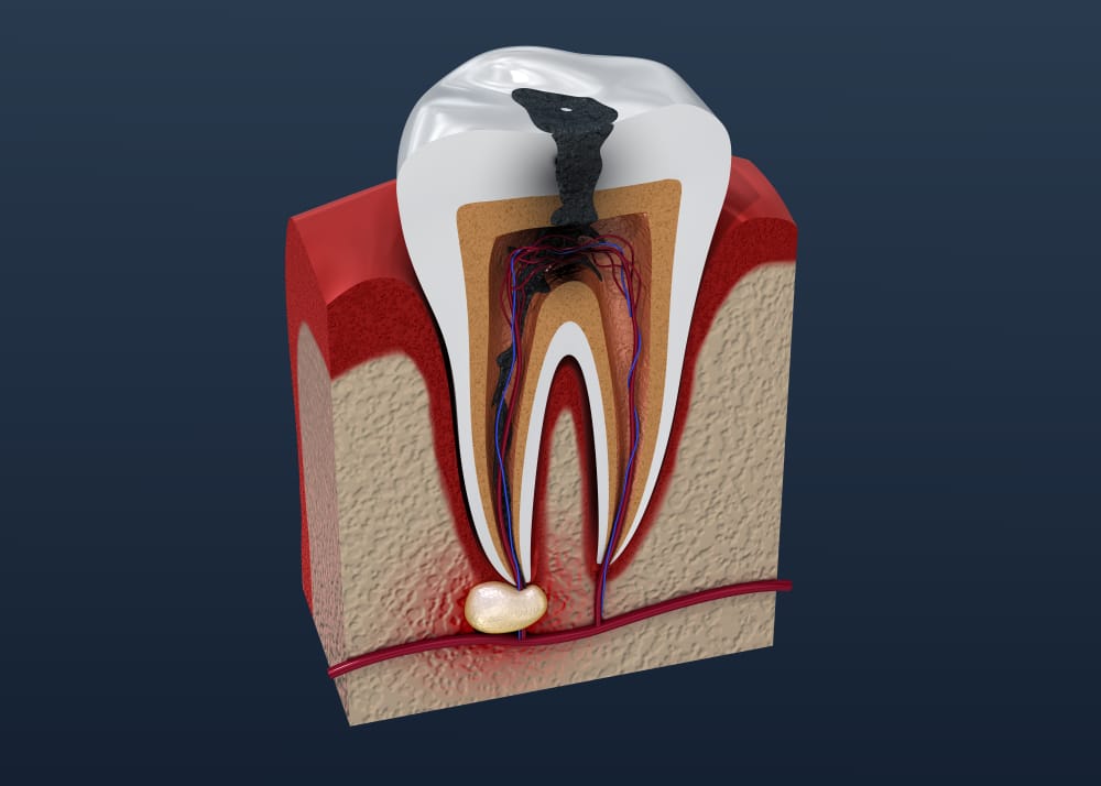 How Do Dentists Treat A Tooth Abscess? - Radiance Family & Cosmetic ...